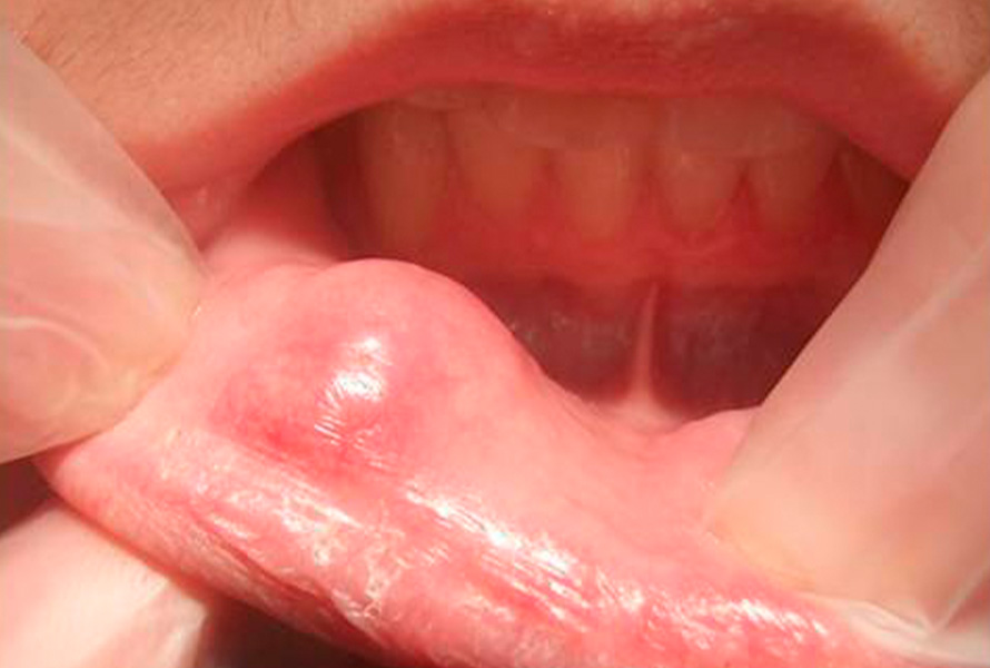 mucocele w